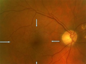 RetinaCare | Epiretinal membrane (pre and post op)