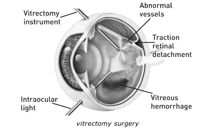vitrectomy_surgery