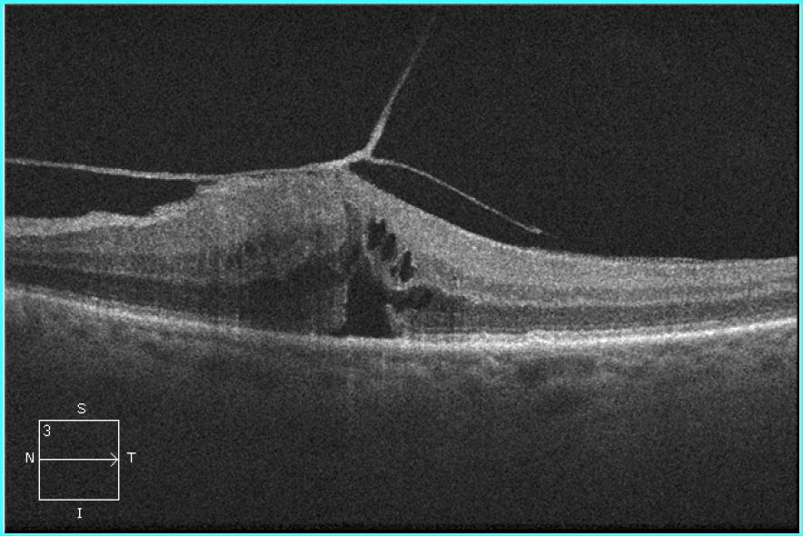 Broad adhesion and epiretinal membrane present - would not respond to ocriplasmin